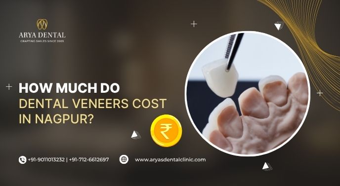 How Much Do Dental Veneers Cost in Nagpur?