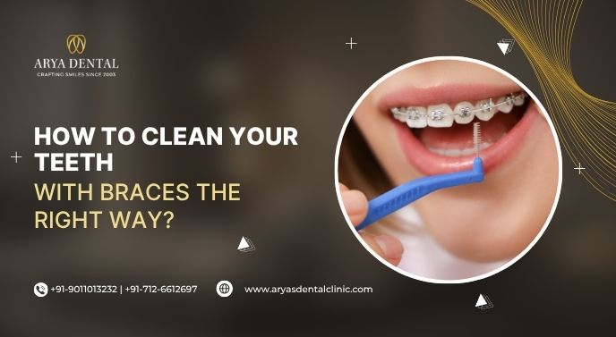 How to Clean Your Teeth with Braces the Right Way