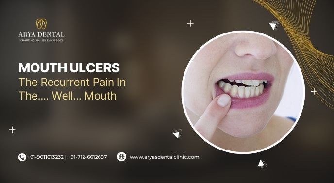 Mouth Ulcers - The Recurrent Pain In The.....Well...Mouth