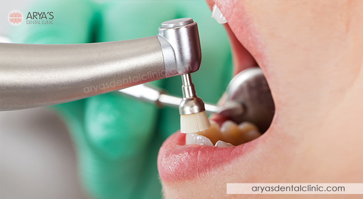 Myths And Facts About Professional Tooth Cleaning