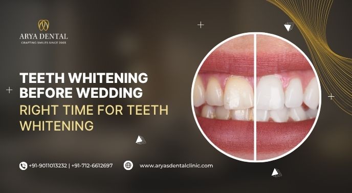 Teeth Whitening Before Wedding Nagpur